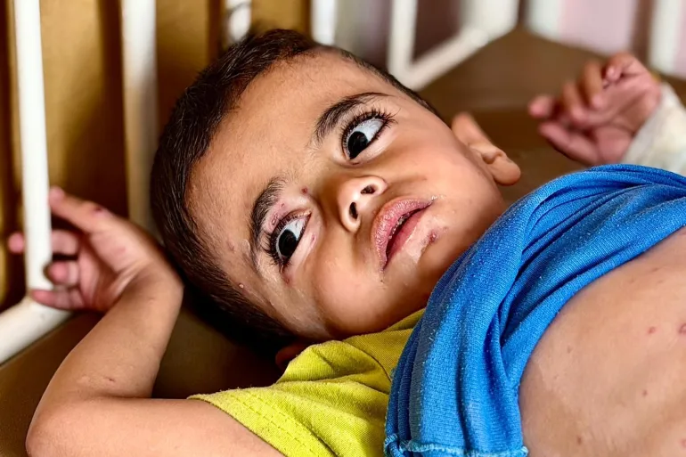 Gaza's Children Face Dire Skin Disease Crisis Amidst Hunger and Overcrowding